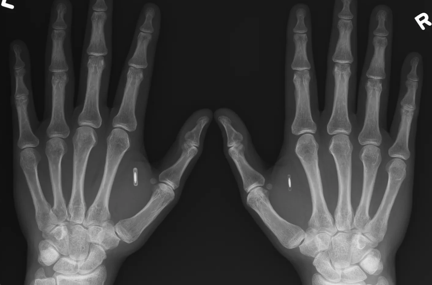 An X-ray image of two human hands positioned palms forward, labeled “L” and “R” for left and right. The skeletal structure of the fingers, palms, and wrists is clearly visible. In each hand, a small, cylindrical metallic object appears implanted in the soft tissue between the thumb and index finger. The implants contrast sharply against the bone in the radiographic image, emphasizing the integration of a technological object within the human body.
