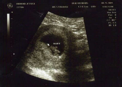 "Ultrasound 7 weeks & 4 days" by jessica.diamond is licensed under CC BY-SA 2.0.